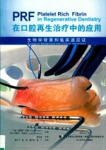PRF在口腔再生治疗中的应用 生物学背景和临床适应证
