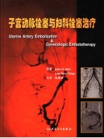 子宫动脉栓塞与妇科栓塞治疗