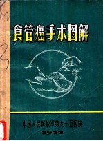 食管癌手术图解