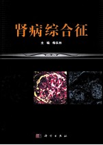 肾病综合征