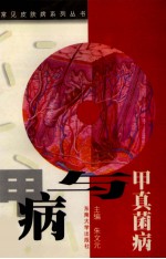 甲真菌病与甲病