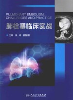 肺栓塞临床实战
