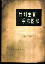 计划生育手术图解
