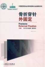 骨折穿针外固定