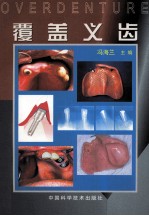 覆盖义齿
