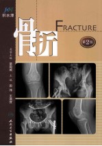 骨折 第2版