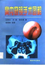 鼻内窥镜手术图解